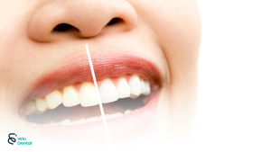 Bọc răng sứ và dán sứ veneer: Khác nhau gì, nên chọn loại nào? 2 10