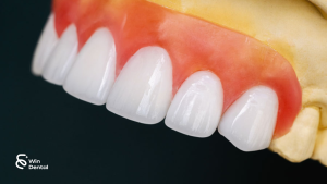 Độ bền của răng sứ thẩm mỹ là bao lâu? 2 Độ bền của răng sứ thẩm mỹ