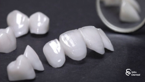 Độ bền của răng sứ thẩm mỹ là bao lâu? 3 Độ bền của từng loại răng sứ thẩm mỹ