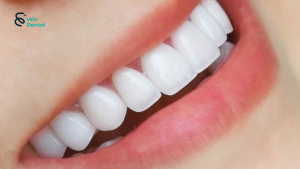 Những ai nên và không nên làm răng sứ? Lời khuyên từ chuyên gia 2 Khách hàng làm răng sứ tại Win Dental
