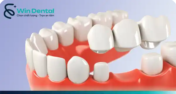 Bọc chụp răng sứ 2 Cầu răng sứ