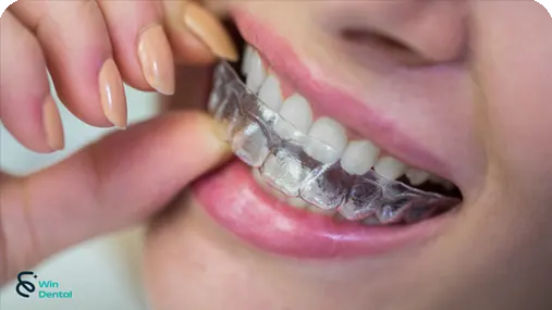 Trang chủ 63 Cong nghe Cong nghe Smart Stage Invisalign V1