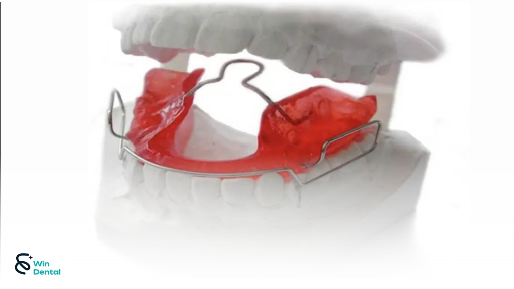 Các loại hàm chỉnh nha sớm phổ biến hiện nay 1 Ham chinh nha som thum