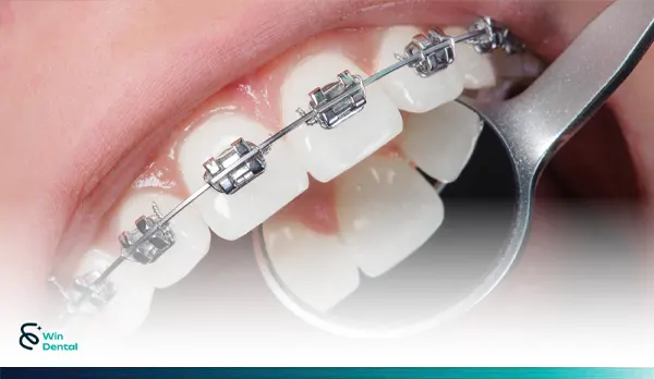 Niềng răng 3 Nieng Rang Nieng rang mac cai