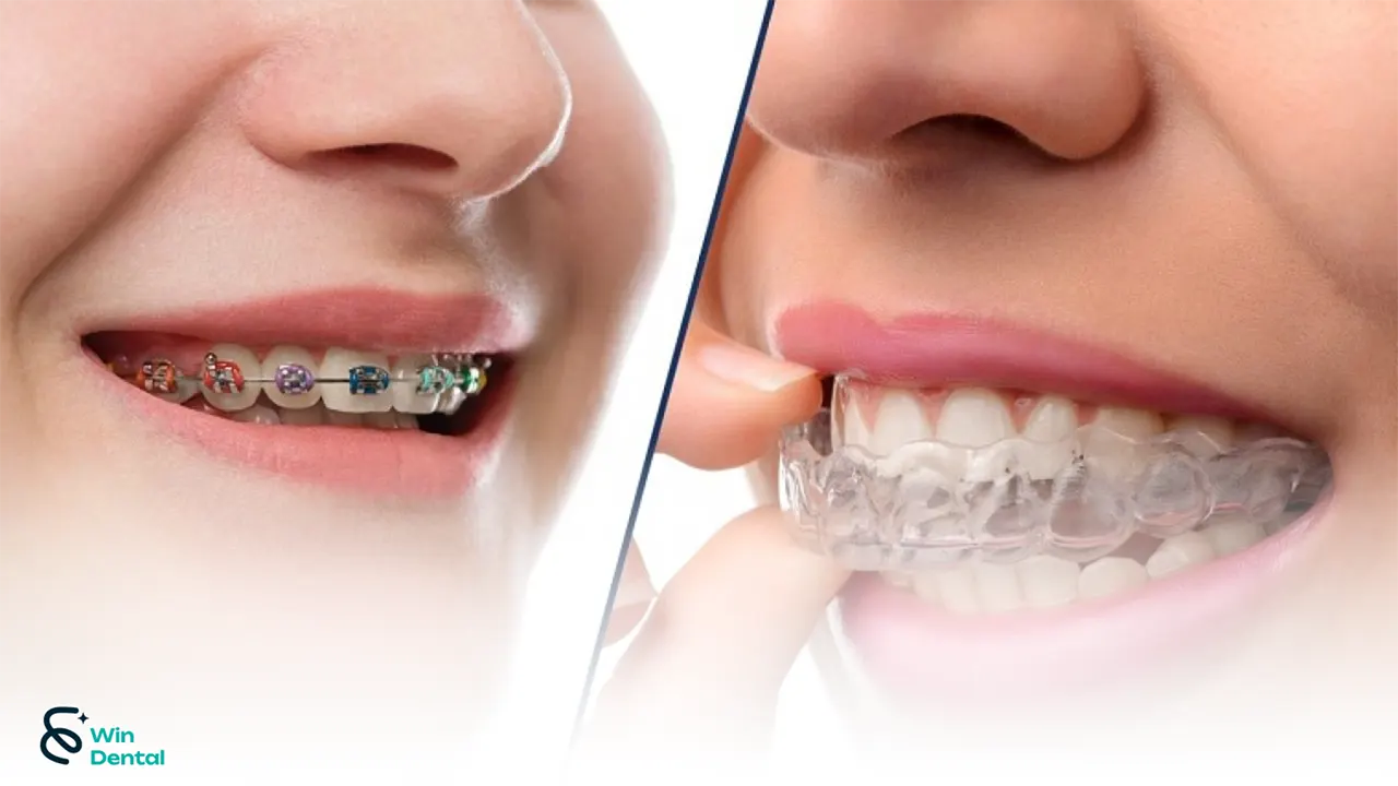 Niềng răng 5 Nieng rang 01