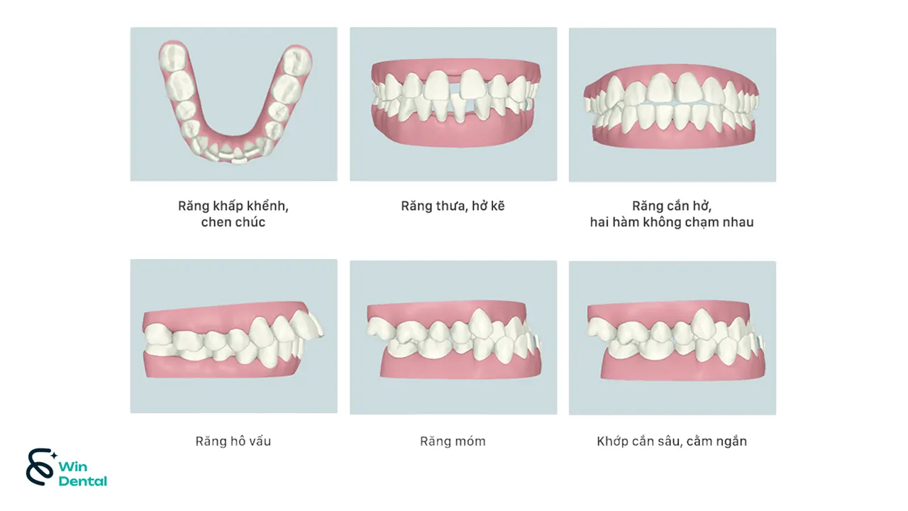 Niềng răng 6 Nieng rang 02