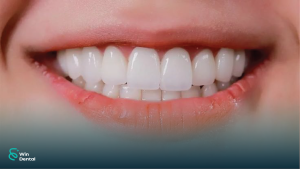 Tổng quan thẩm mỹ răng sứ: Ai nên làm, có đau không, giá mới nhất 2 Thẩm mỹ răng sứ: Ai nên làm, có đau không, giá mới nhất