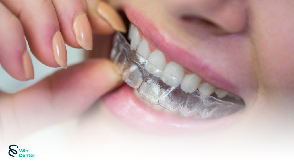 Công nghệ Smart Stage – Invisalign: Bước tiến mới trong niềng răng trong suốt 1 nieng 2