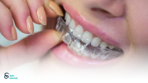 Công nghệ Smart Stage – Invisalign: Bước tiến mới trong niềng răng trong suốt 3 Công nghệ Smart Stage – Invisalign: Bước tiến mới trong niềng răng trong suốt