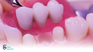 Bọc chụp răng sứ 5 Cầu răng sứ – Giải pháp phục hình răng mất hiệu quả