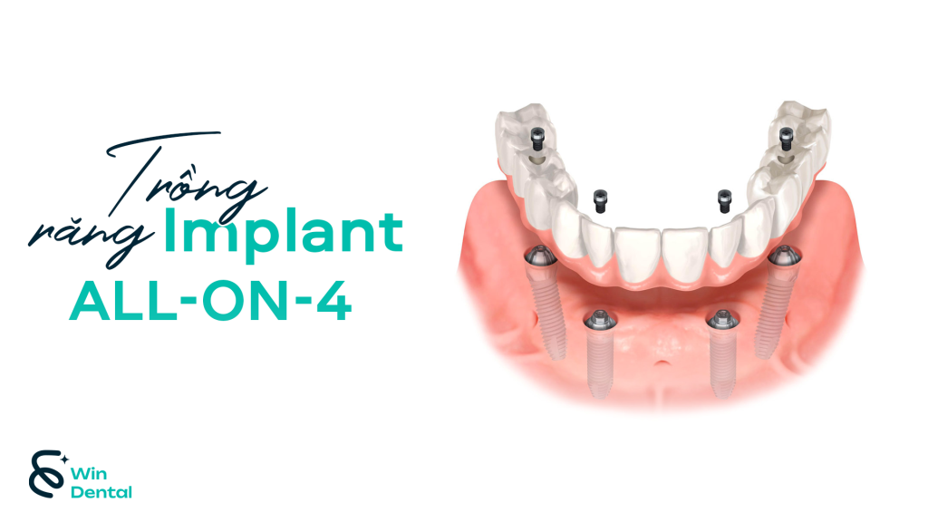 Trồng răng Implant All-on-4: Quy trình, chỉ định và chi phí 1 Trồng răng Implant All-on-4