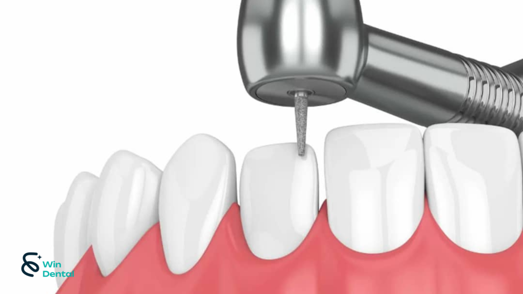 Làm răng sứ có phải mài hết răng thật không? 1 59