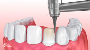 Làm răng sứ có phải mài hết răng thật không? 2 Làm răng sứ thẩm mỹ đang trở thành xu hướng giúp nhiều người sở hữu nụ cười trắng sáng và đều đẹp