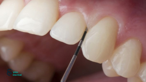 Làm răng sứ có phải mài hết răng thật không? 4 Khi nào cần mài nhiều răng thật hơn?