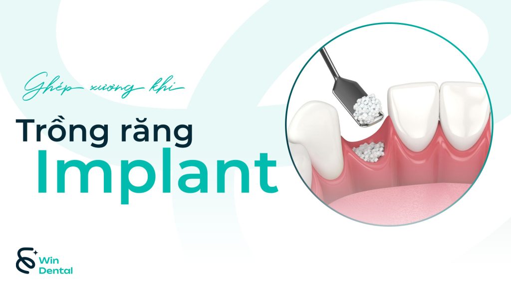 Ghép xương khi trồng răng Implant: Khi nào cần và có đau không? 1 Ghep xuong khi trong rang Implant