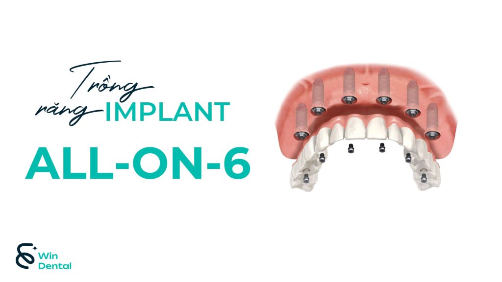 Trồng răng Implant All-on-6: Khi nào nên chọn 6 trụ? 1 Implant all on 6 3
