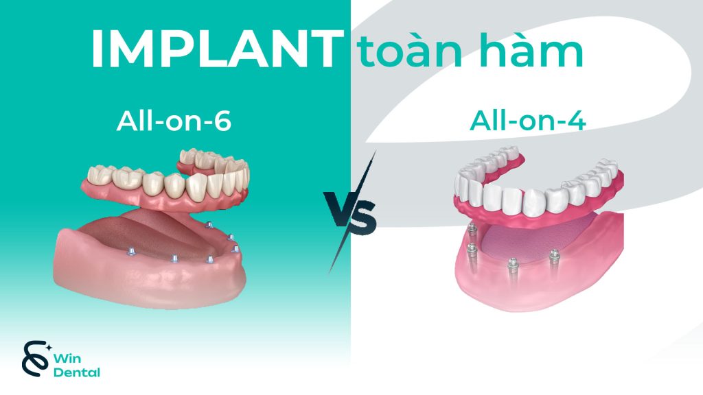 Trồng răng Implant toàn hàm: Chiến lược điều trị và phục hình 1 Implant toan ham