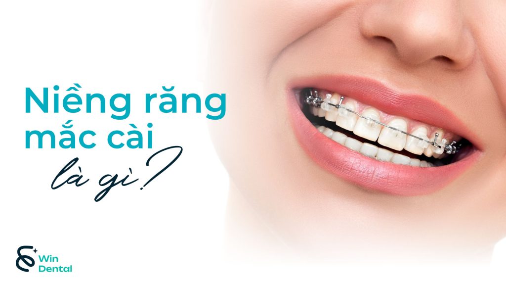 Niềng răng mắc cài là gì? Cơ chế hoạt động & lợi ích chi tiết 1 Nieng rang mac cai la gi thum
