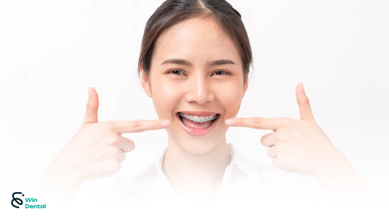 Niềng răng mắc cài 15 Niềng răng mắc cài