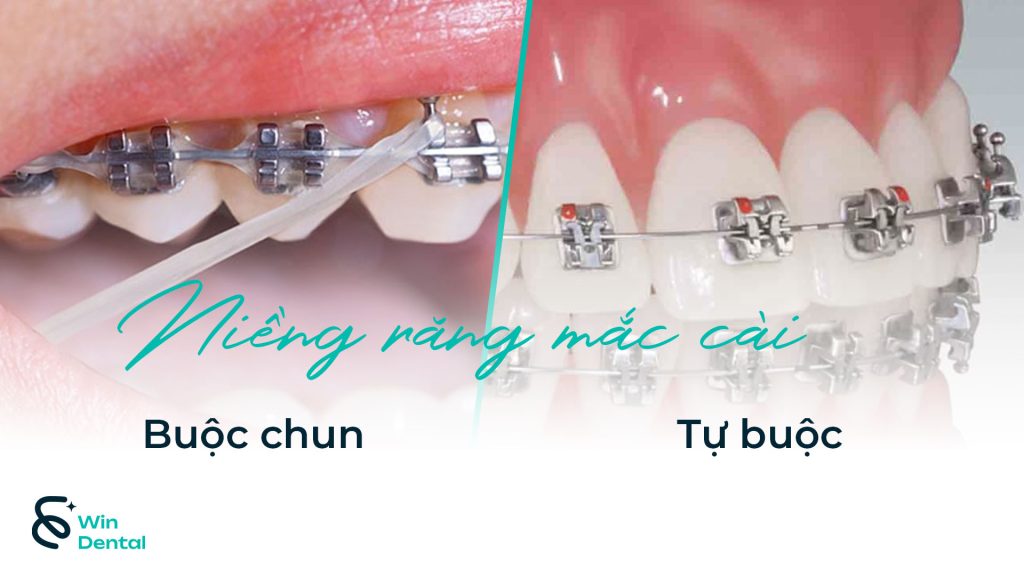 Phân loại niềng răng mắc cài theo cơ chế – Niềng răng có buộc chun & tự buộc 1 Phan loai nieng rang mac cai theo co che