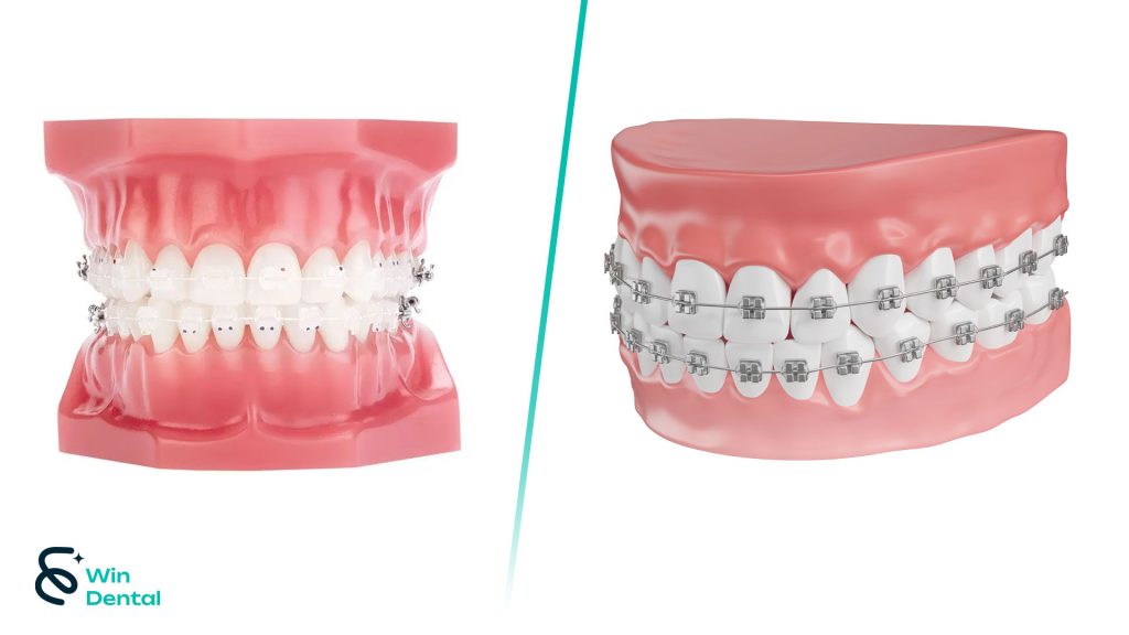 Phân loại niềng răng mắc cài theo vật liệu – Niềng răng kim loại & niềng răng sứ 1 Phan loai nieng rang mac cai theo vat lieu