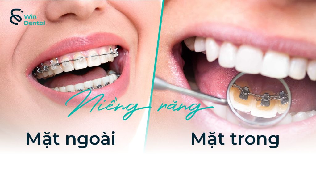Phân loại niềng răng mắc cài theo vị trí – Niềng răng mặt ngoài & niềng răng mặt trong (mặt lưỡi) 1 Phan loai nieng rang theo vi tri thum