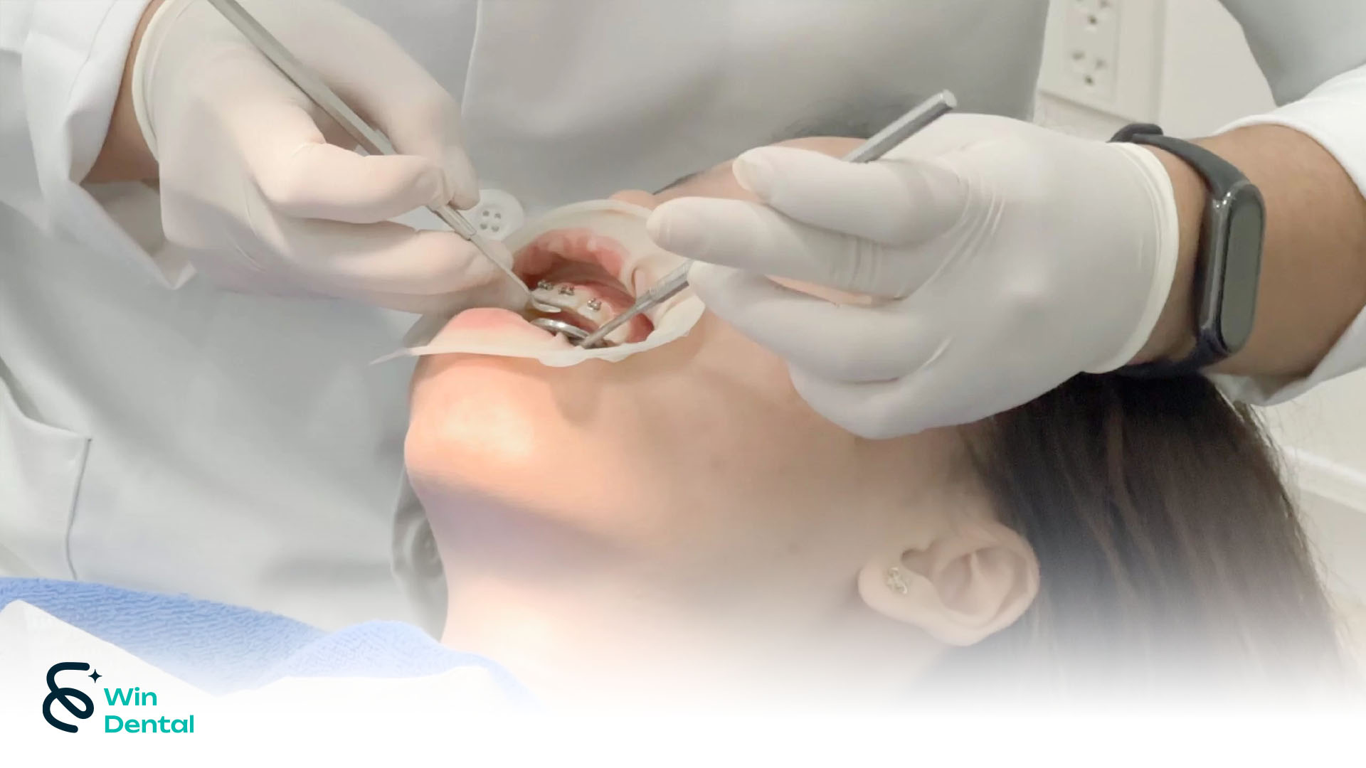 Quy trình niềng răng mắc cài từ A–Z: Hiểu rõ từng bước để yên tâm chỉnh nha 3 Gắn mắc cài được xem là một trong những bước quan trọng nhất trong quy trình niềng răng mắc cài