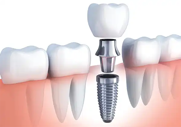 Trang chủ 52 Trong rang Implant 1