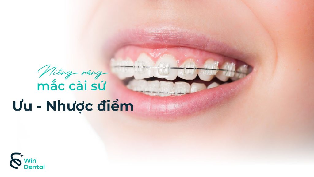 Ưu & Nhược Điểm Niềng Răng Mắc Cài Sứ - Giải Pháp Chỉnh Nha Thẩm Mỹ Hiện Đại | Win Dental 1 Uu nhuoc diem Nieng rang mac cai su thum