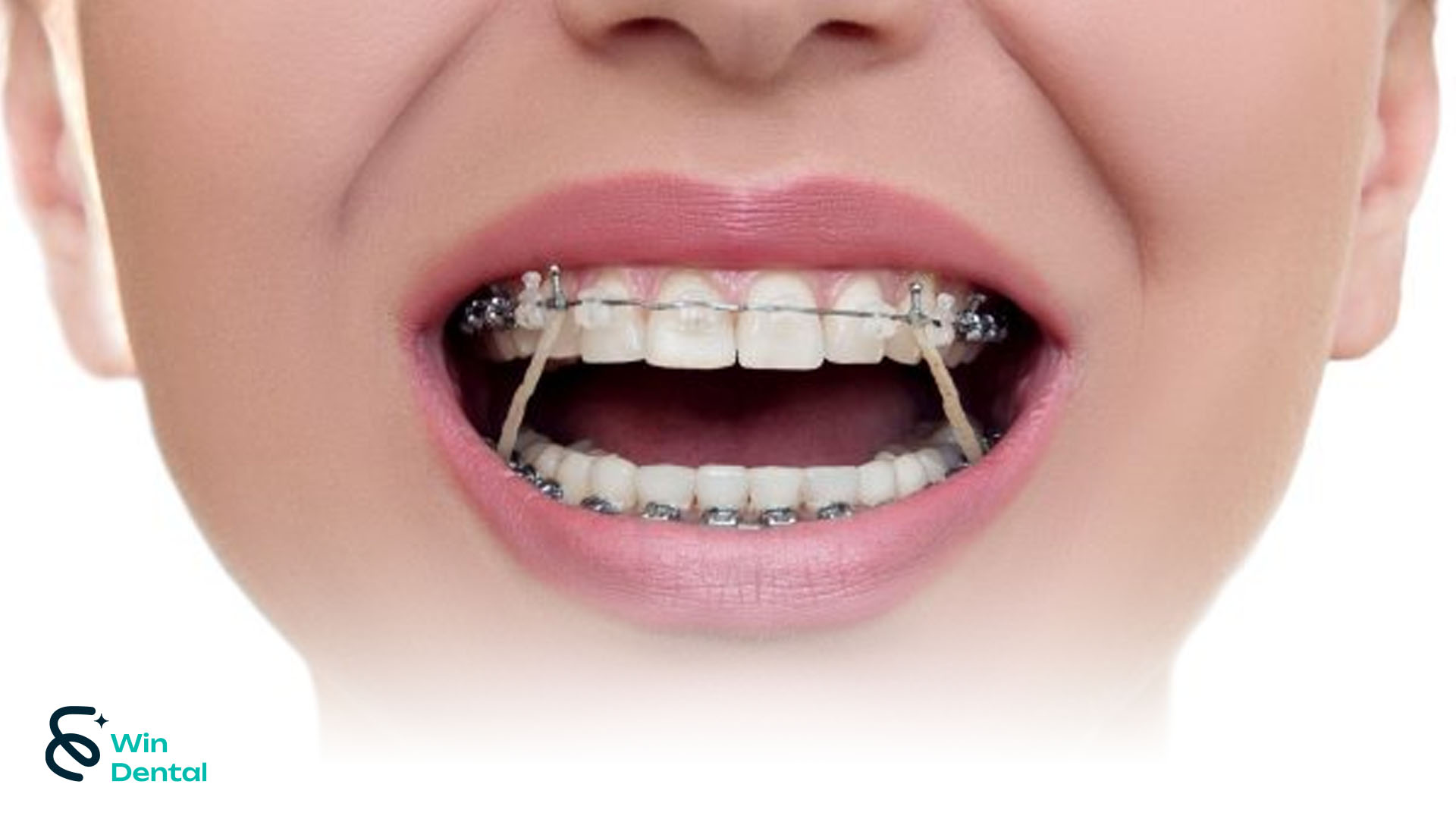 Ưu & Nhược Điểm Niềng Răng Mắc Cài Buộc Chun – Giải Pháp Chỉnh Nha Phổ Biến Nhất Hiện Nay 2 Niềng răng mắc cài buộc chun là dịch vụ chỉnh nha được ưa chuộng hiện nay