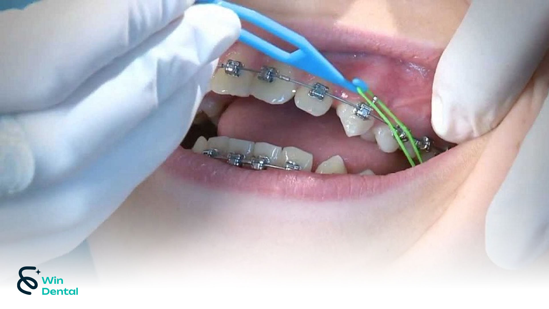 Ưu & Nhược Điểm Niềng Răng Mắc Cài Buộc Chun – Giải Pháp Chỉnh Nha Phổ Biến Nhất Hiện Nay 3 Niềng răng mắc cài buộc chun đem lại hiệu quả ấn tượng