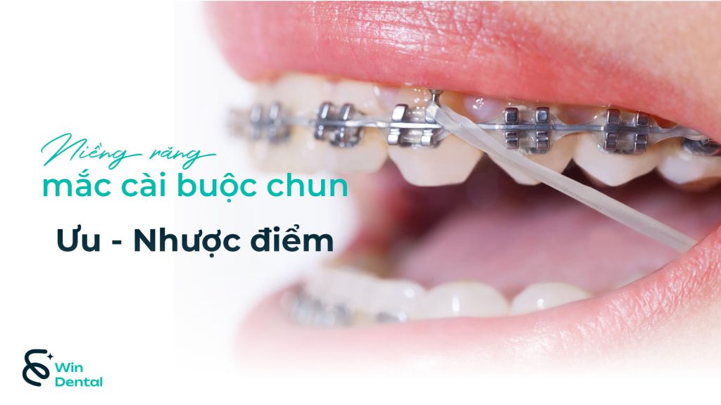 Ưu & Nhược Điểm Niềng Răng Mắc Cài Buộc Chun – Giải Pháp Chỉnh Nha Phổ Biến Nhất Hiện Nay 1 Uu nhuoc diem nieng rang mac cai buoc chun thum