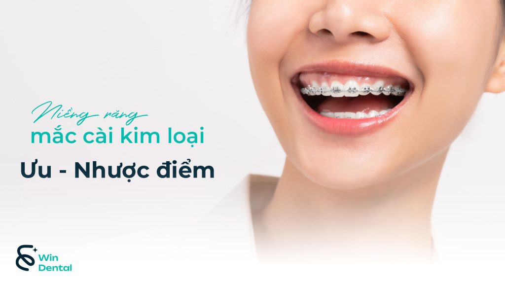 Ưu & Nhược điểm Niềng răng mắc cài kim loại – Lựa chọn kinh điển trong chỉnh nha 1 Ưu nhược điểm của niềng răng mắc cài kim loại