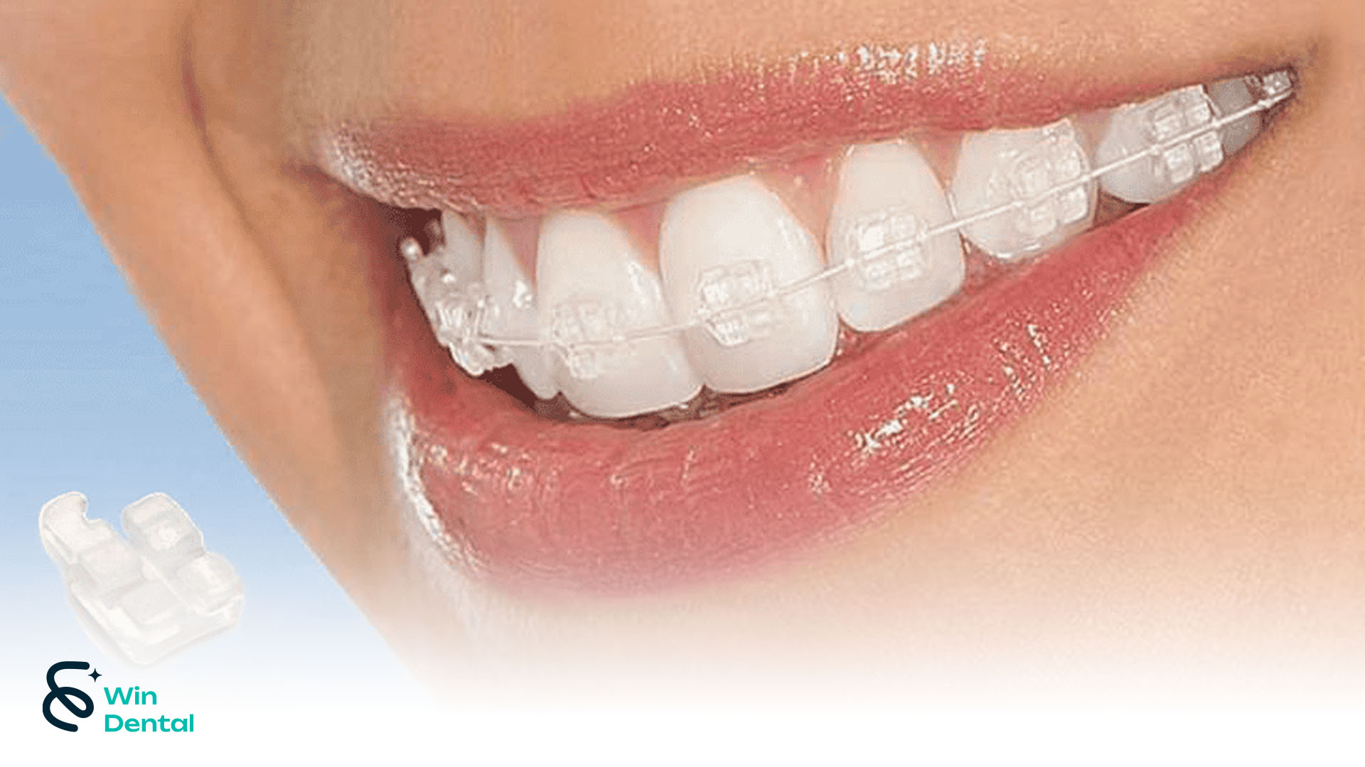 Ưu & Nhược Điểm Niềng Răng Mắc Cài Sứ - Giải Pháp Chỉnh Nha Thẩm Mỹ Hiện Đại | Win Dental 2 Niềng răng mắc cài sứ là lựa chọn hàng đầu cho những ai muốn chỉnh nha kín đáo