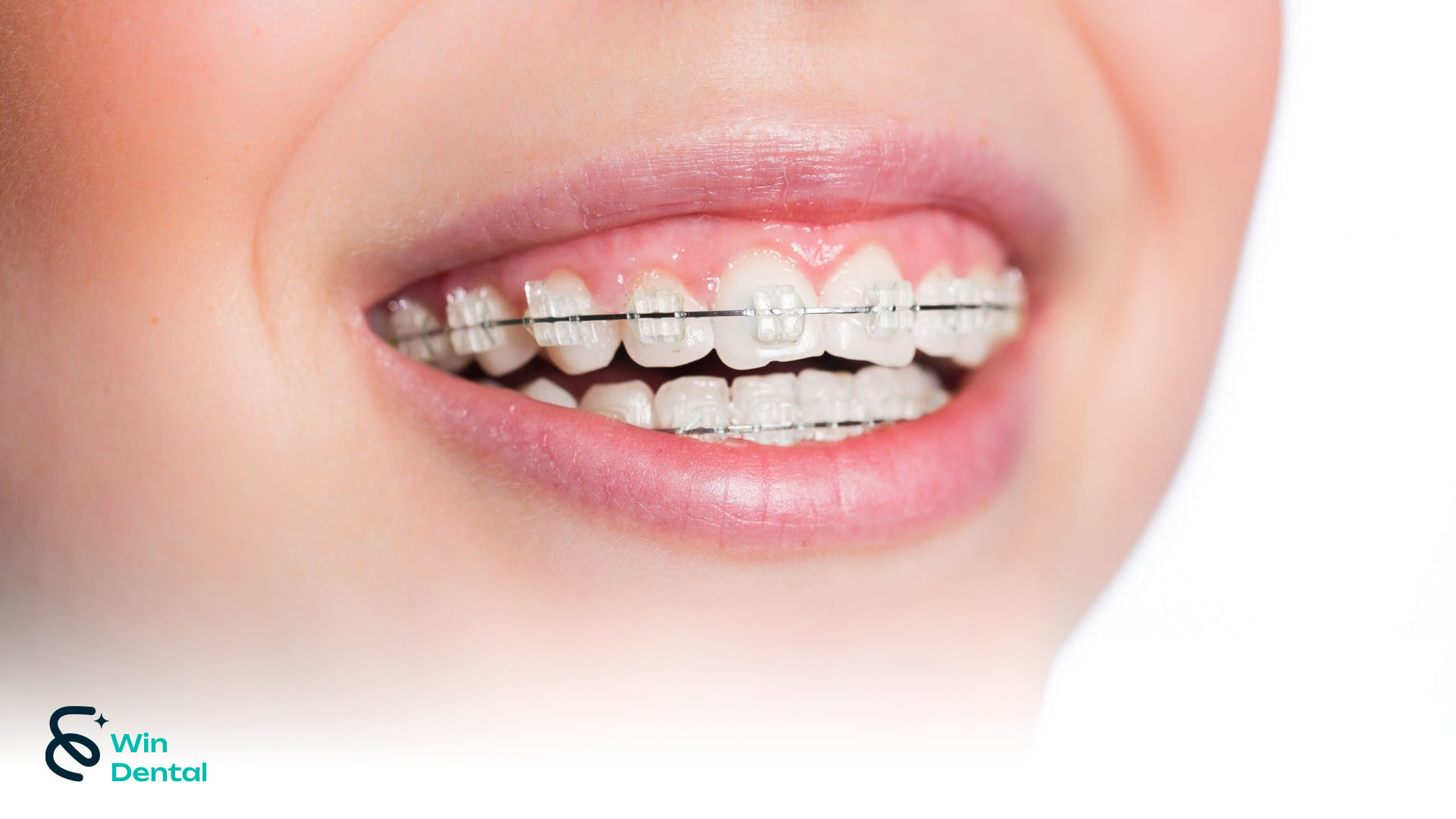 Ưu & Nhược Điểm Niềng Răng Mắc Cài Sứ - Giải Pháp Chỉnh Nha Thẩm Mỹ Hiện Đại | Win Dental 3 Niềng răng mắc cài sứ sở hữu hàng loạt ưu điểm vượt trội