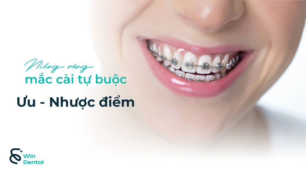 Ưu & Nhược Điểm Niềng Răng Mắc Cài Tự Buộc – Công Nghệ Chỉnh Nha Thế Hệ Mới 1 Uu nhuoc diem nieng rang mac cai tu buoc