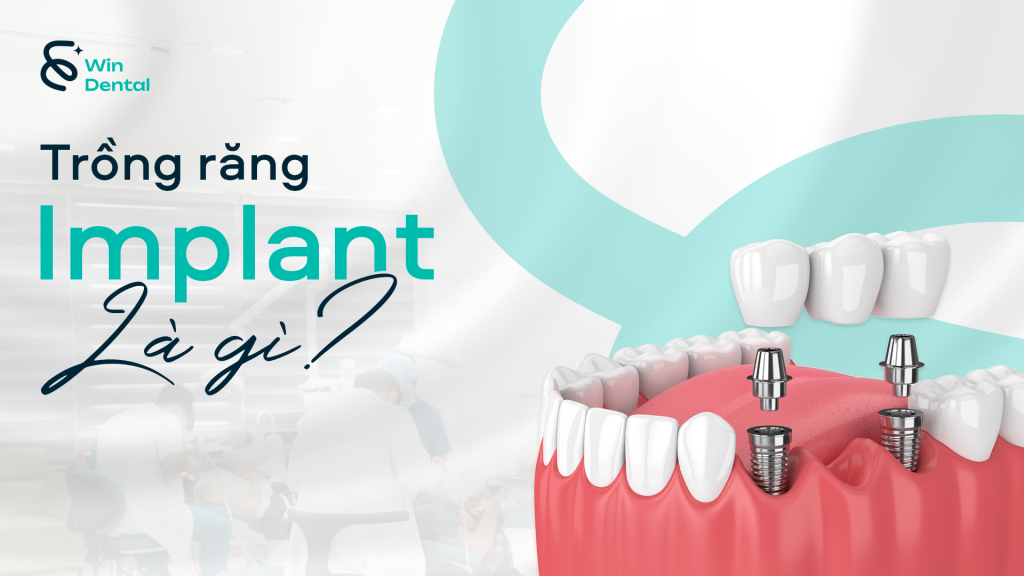 Trồng răng Implant là gì? Cấu tạo và nguyên lý hoạt động của răng Implant 1 trong rang implant la gi thum