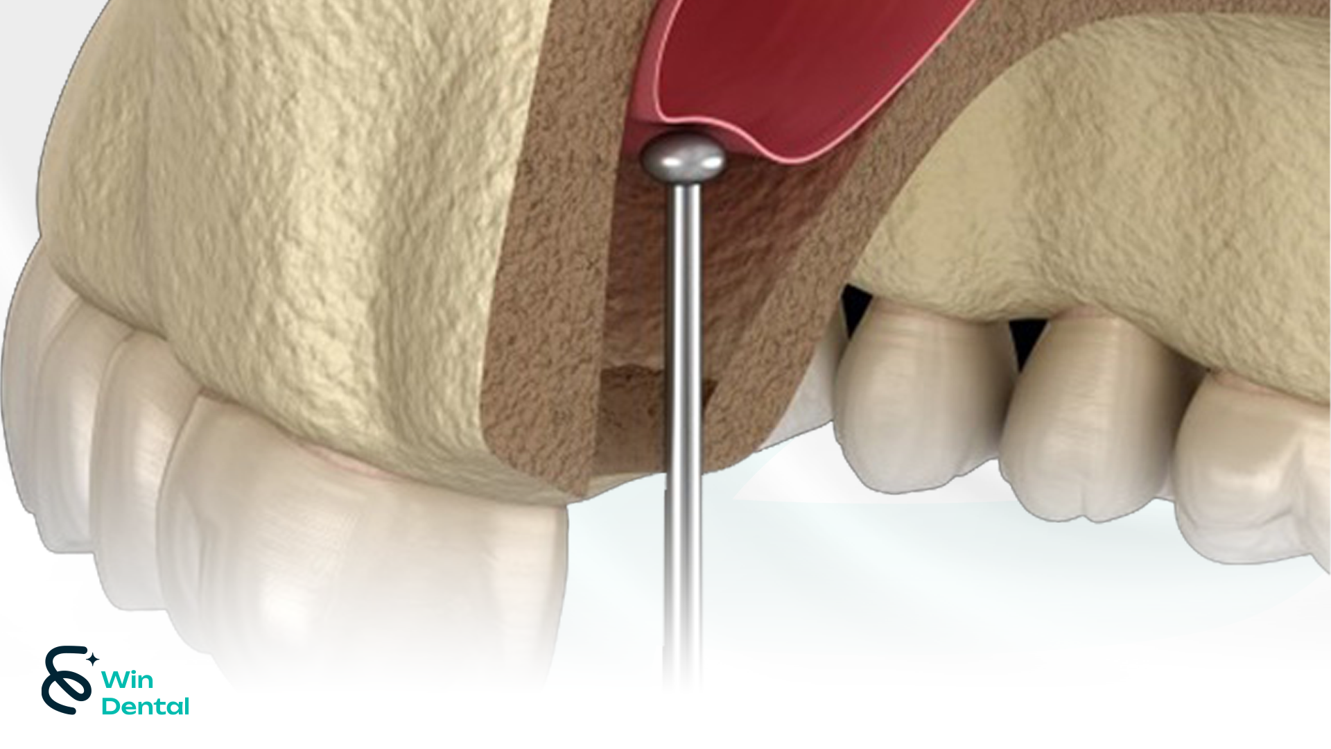 Nâng xoang khi trồng răng Implant: Kỹ thuật kín - hở - thủy lực 2 Nâng xoang kín là kỹ thuật khá phổ biến trong trường hợp cần thực hiện nâng xoang khi trồng răng Implant