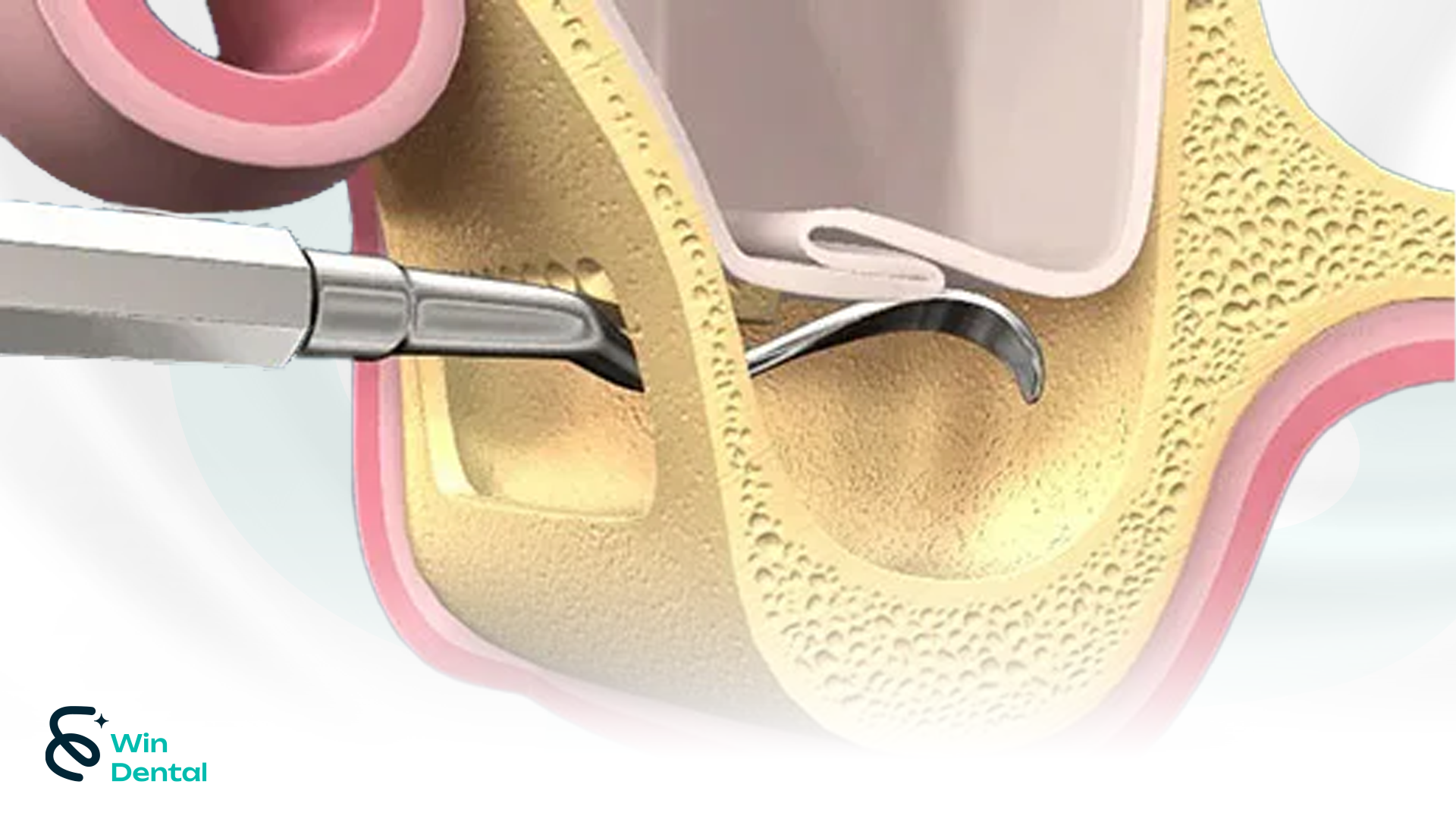 Nâng xoang khi trồng răng Implant: Kỹ thuật kín - hở - thủy lực 3 Nâng xoang hở khi trồng răng Implant được chỉ định khi tiêu xương khá nặng