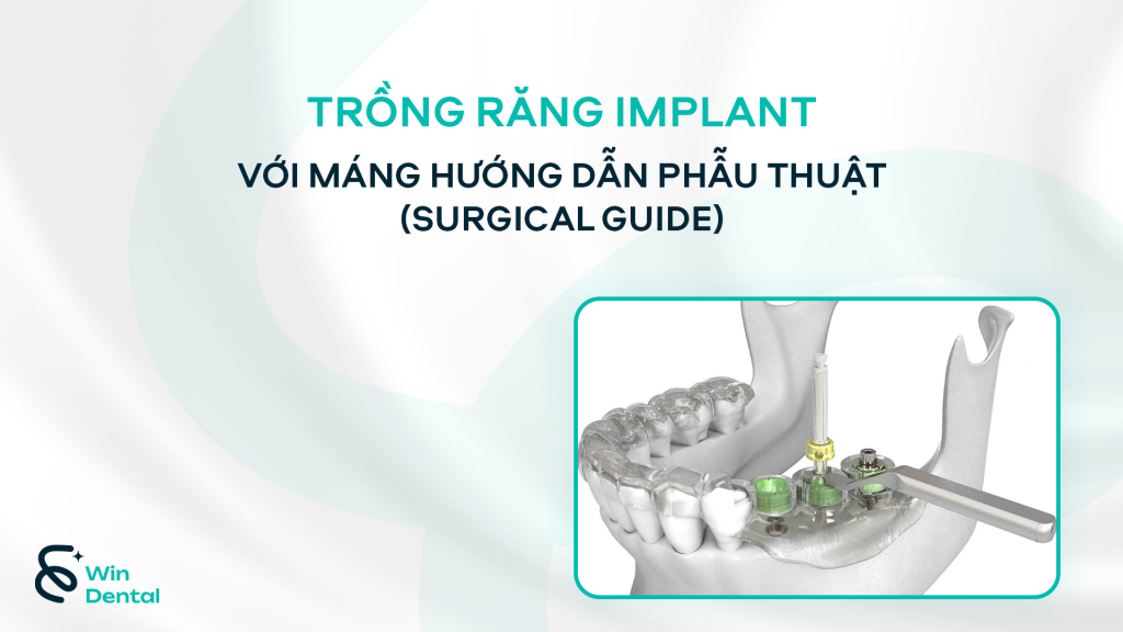 Trồng răng Implant với máng hướng dẫn phẫu thuật (Surgical Guide) 1 3 1