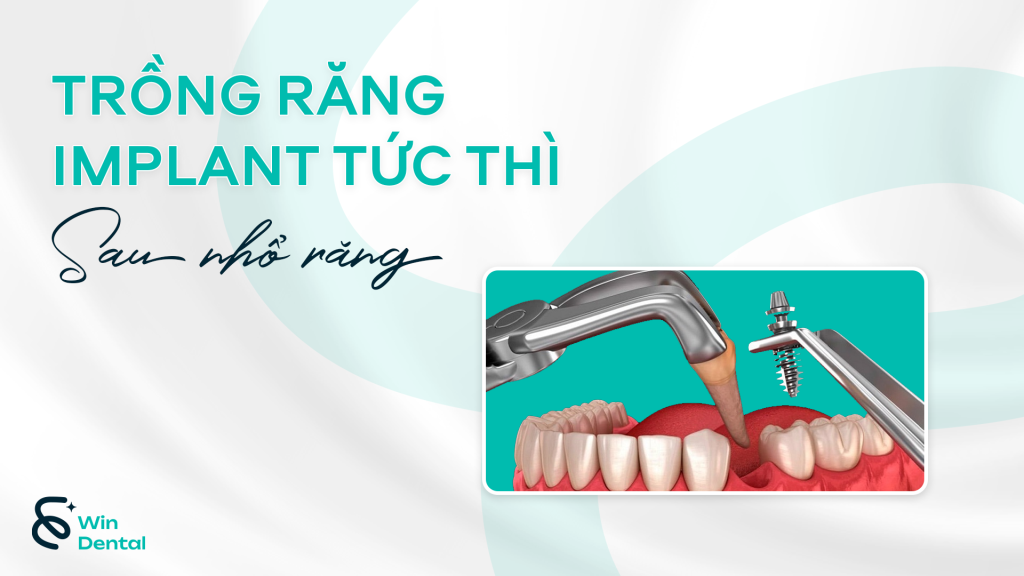 Trồng răng Implant tức thì sau nhổ răng: Ưu điểm và lưu ý 1 5