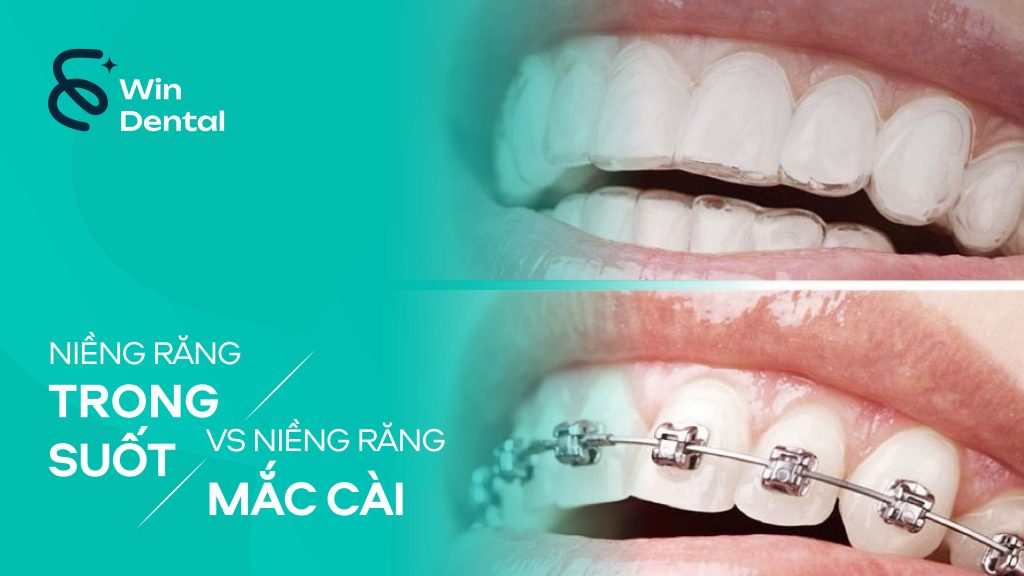 So sánh Niềng răng trong suốt Invisalign và niềng mắc cài – Đâu là lựa chọn phù hợp nhất? 1 Nieng rang trong suot vs Nieng rang mac cai 01