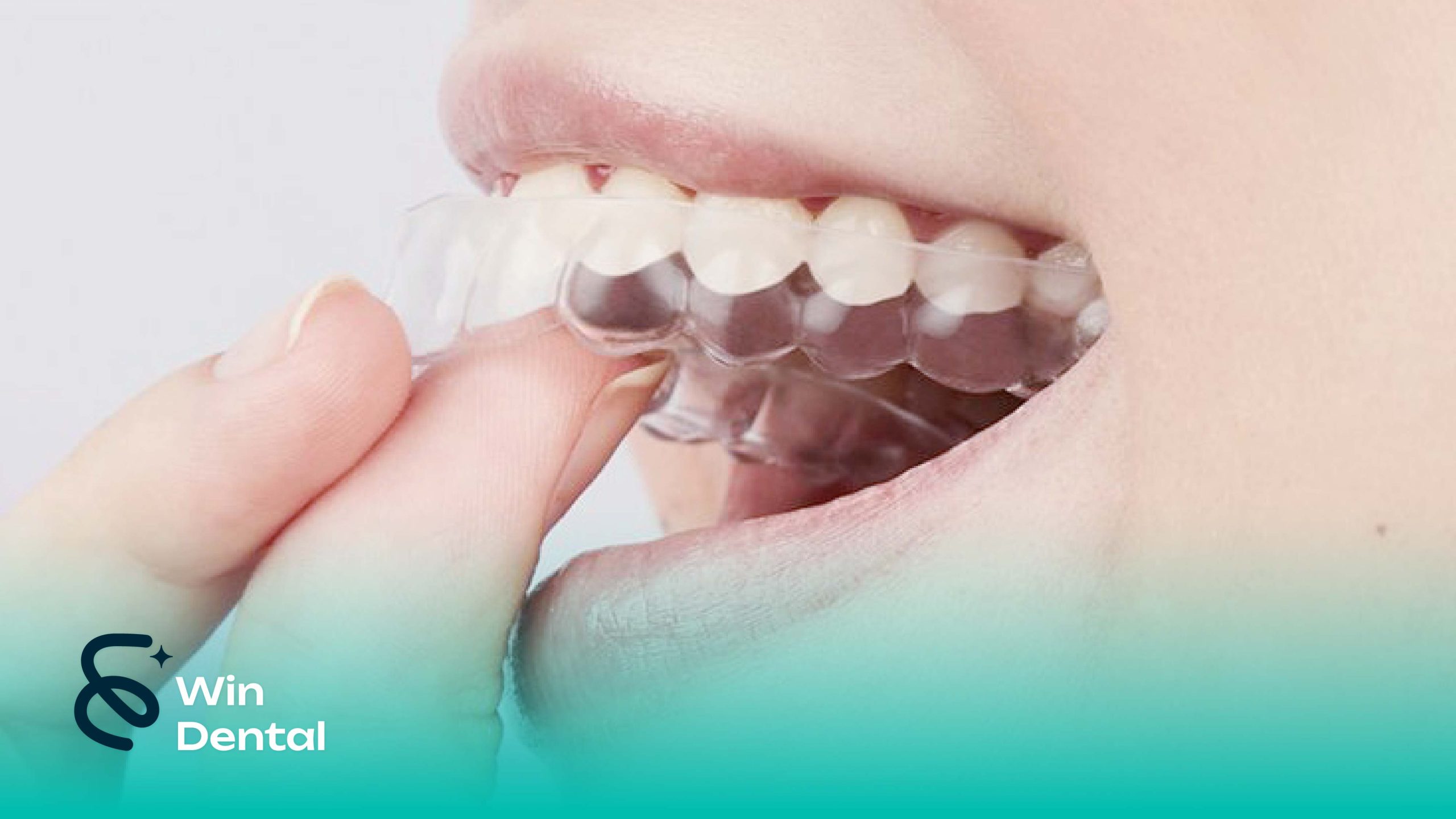 So sánh Niềng răng trong suốt Invisalign và niềng mắc cài – Đâu là lựa chọn phù hợp nhất? 2 Niềng răng trong suốt Invisalign và niềng mắc cài - đâu là sự lựa chọn vượt trội?