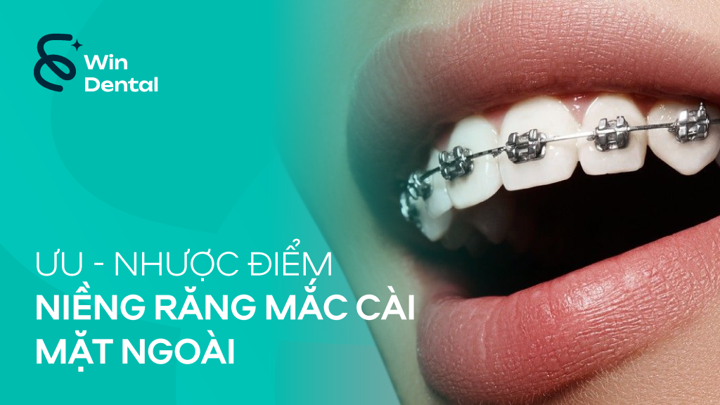 Ưu & nhược điểm niềng răng mắc cài mặt ngoài – Phương pháp truyền thống, hiệu quả cao 1 Uu nhuoc diem nieng rang mac cai mat ngoai