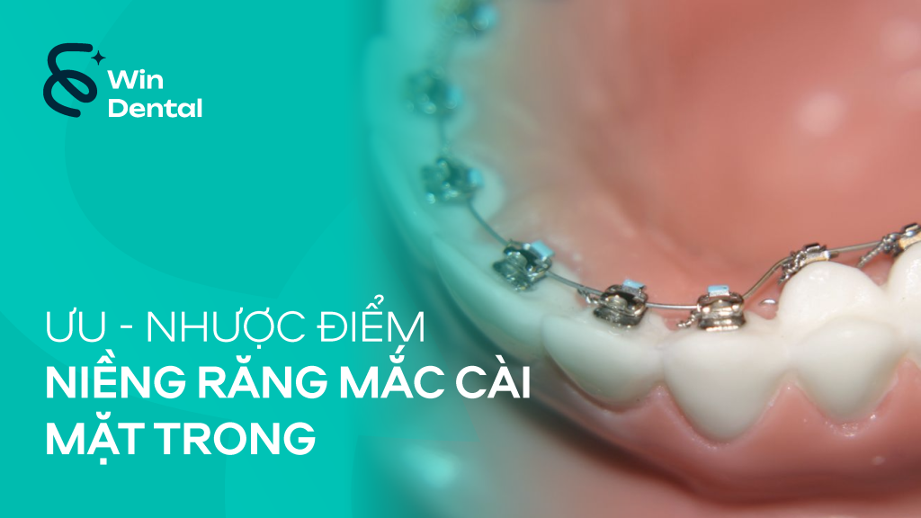 Ưu & nhược điểm niềng răng mắc cài mặt trong – Giải pháp “vô hình” cho nụ cười hoàn hảo 1 Uu nhuoc diem nieng rang mac cai mat trong 01