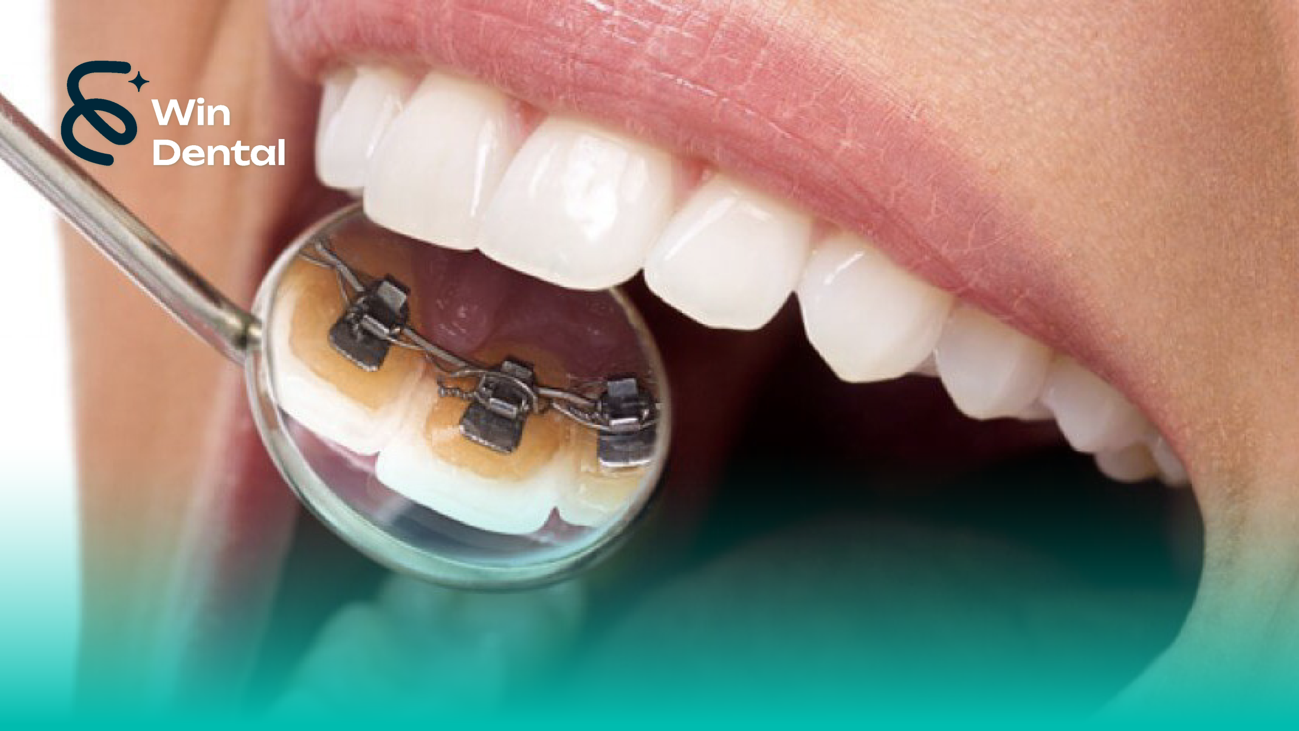 Ưu & nhược điểm niềng răng mắc cài mặt trong – Giải pháp “vô hình” cho nụ cười hoàn hảo 2 Ưu điểm vượt trội của Niềng răng mắc cài mặt trong nằm ở tính thẩm mỹ