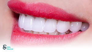 Răng sứ có bị xỉn màu theo thời gian không? 2 Răng sứ có bị xỉn màu theo thời gian không?