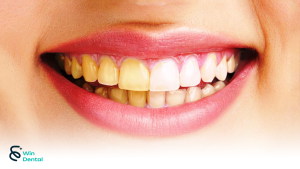 Răng sứ có bị xỉn màu theo thời gian không? 3 Những nguyên nhân khiến răng sứ bị xỉn màu