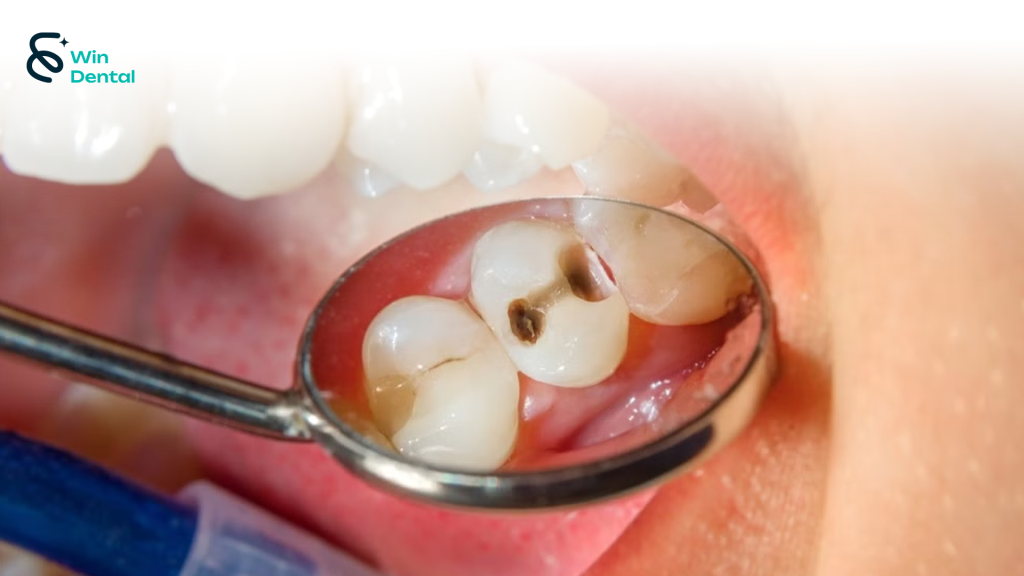 Sâu răng: Nguyên nhân, triệu chứng và cách điều trị hiệu quả tại Win Dental 1 4 1