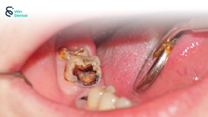 Sâu răng: Nguyên nhân, triệu chứng và cách điều trị hiệu quả tại Win Dental 2 âu răng là một trong những bệnh lý răng miệng phổ biến nhất